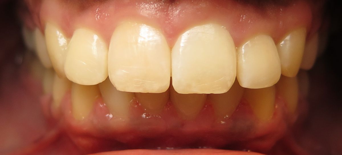 After Invisalign Spacing & Gum Health Beverly Chicago